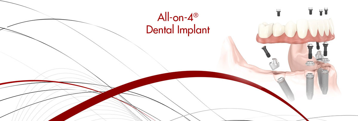 Sioux Falls All-on-4 Dental Implants