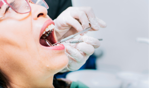 Dentist placing a tooth-colored composite filling during a cavity treatment procedure