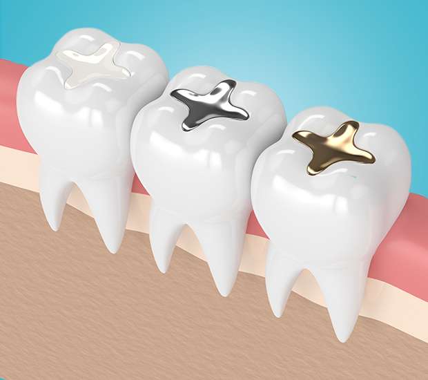 Sioux Falls Tooth Colored Fillings