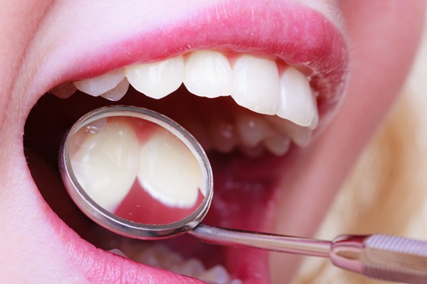 What To Avoid After Getting A New Dental Filling
