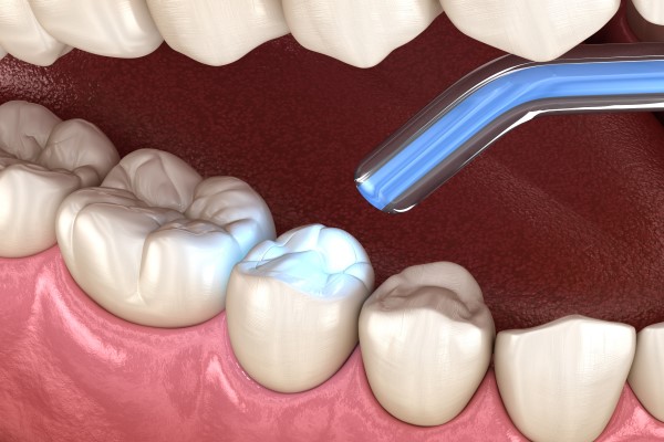 When Is A Dental Filling Needed?