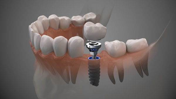 Dental Implants Sioux Falls, SD