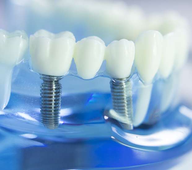 Sioux Falls Dental Prosthetics