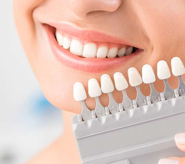 Sioux Falls Veneers