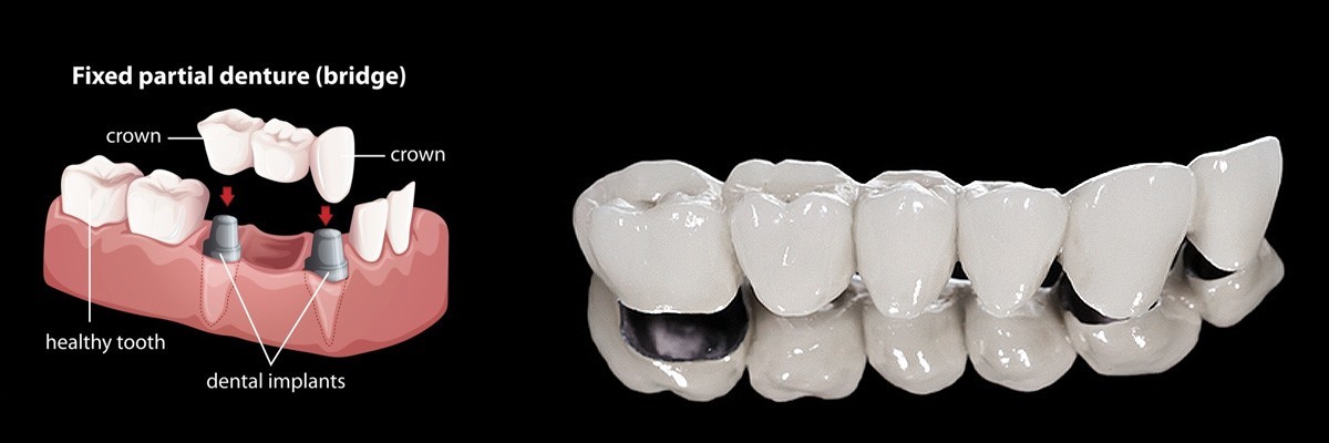 Sioux Falls Dentures