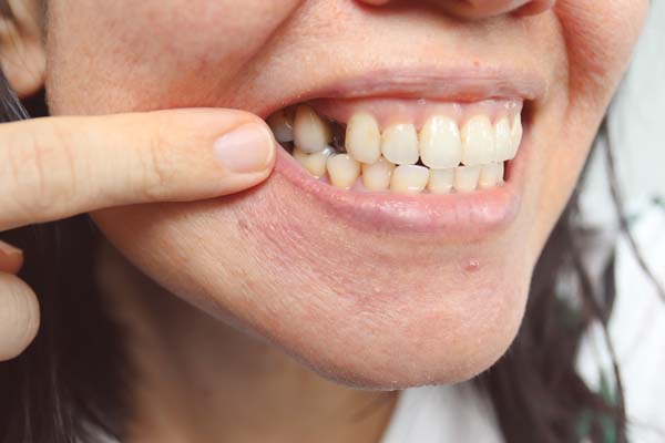 Replace Missing Teeth With Dental Bridges