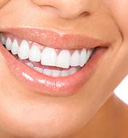 Teeth Whitening Services Sioux Falls, SD