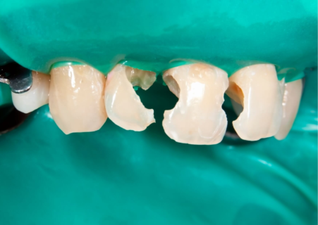 Close-up of front teeth with visible fractures and broken enamel, showing what a cracked tooth looks like before dental restoration.