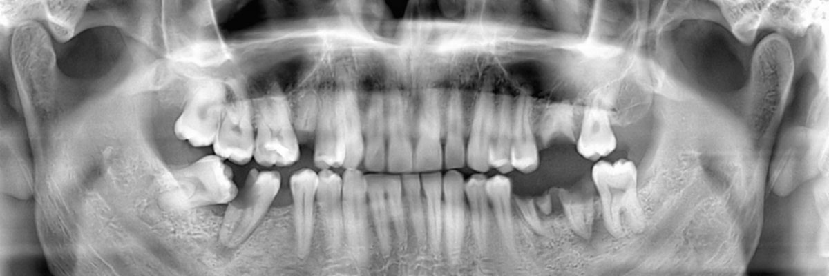 Sioux Falls Wisdom Teeth Extraction